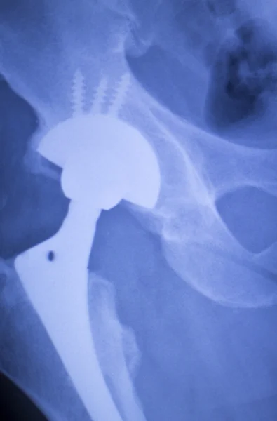 Wymiany stawu biodrowego xray ortopedyczne medyczne skanowania — Zdjęcie stockowe