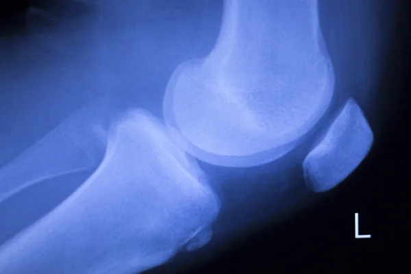 Lesión de rodilla y menisco Tomografía de rayos X —  Fotos de Stock