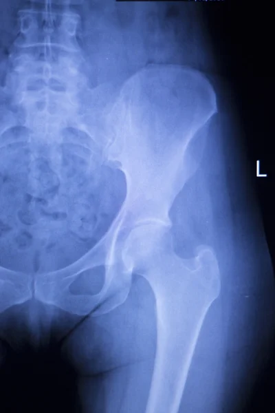 Lesión de cadera rayos X exploración médica — Foto de Stock