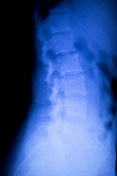 Spine vertebra back injury xray scan — Stock Photo, Image