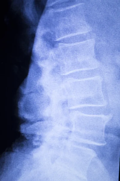 척추 척추 허리 부상 엑스레이 검사 — 스톡 사진