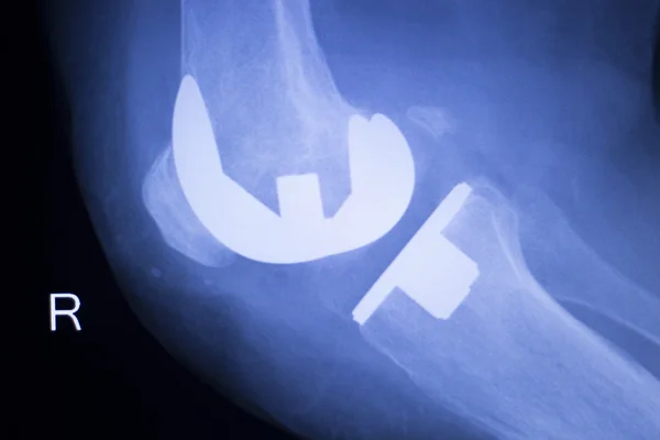 Knee orthopedic implant xray scan — Stock Photo, Image