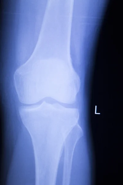 Diz ve Menisküs yaralanma xray tarama — Stok fotoğraf