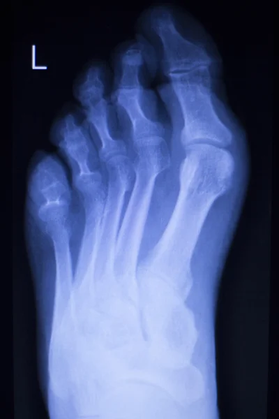 Foot and toes injury xray scan — Stock Photo, Image