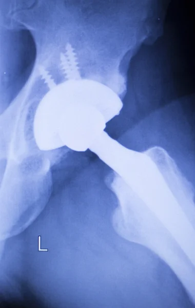 Hip replacement xray orthopedic medical scan