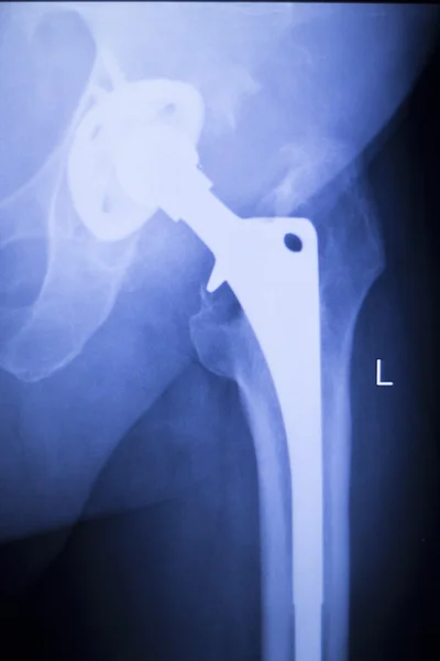 Hip replacement xray orthopedic medical scan — Stock Photo, Image