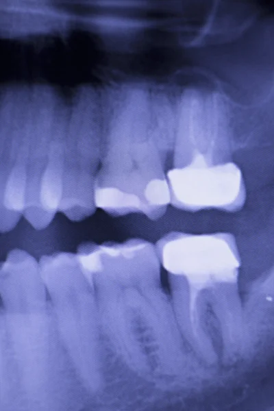 Zahnfüllungen Zahnärzte Röntgen-Scan — Stockfoto