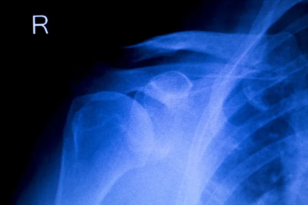 Wirbelsäule Rippen Rückenverletzung Röntgenbild — Stockfoto