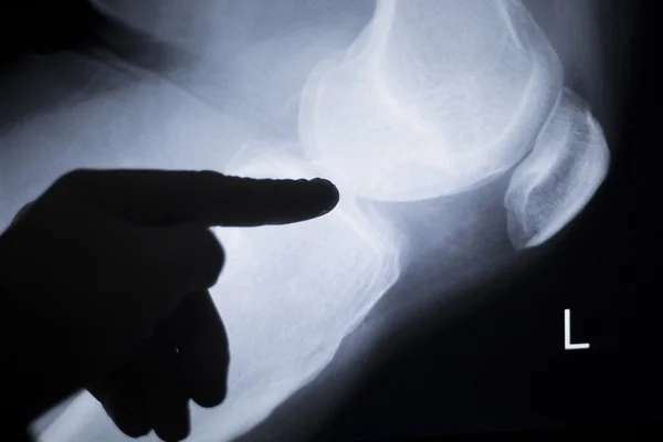 Lesión de rodilla cirujano radiografía —  Fotos de Stock