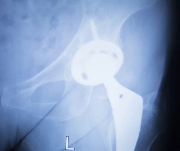 Exploración por rayos X de implante de metal de reemplazo de cadera — Foto de Stock