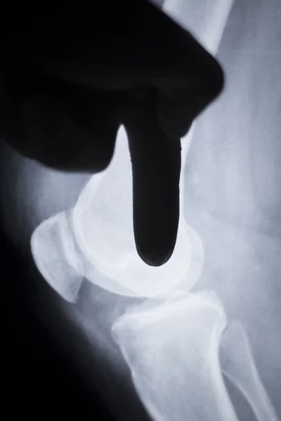 Chirurgien des blessures au genou radiographie — Photo