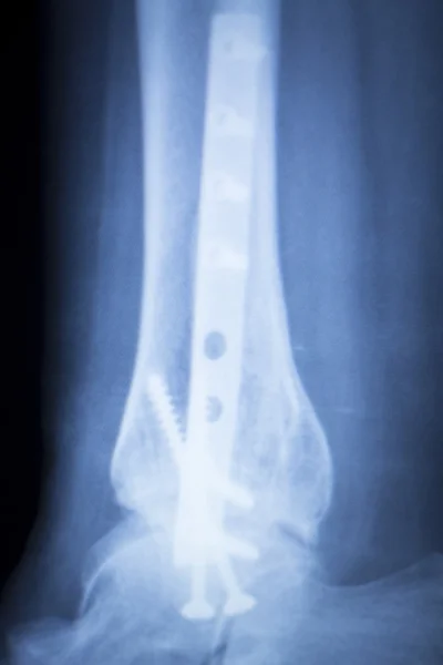 Exploración de rayos X de implante de metal con lesión en el tobillo — Foto de Stock