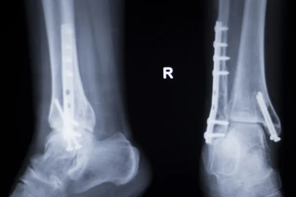 踝关节损伤金属植入物的 x 射线扫描 — 图库照片
