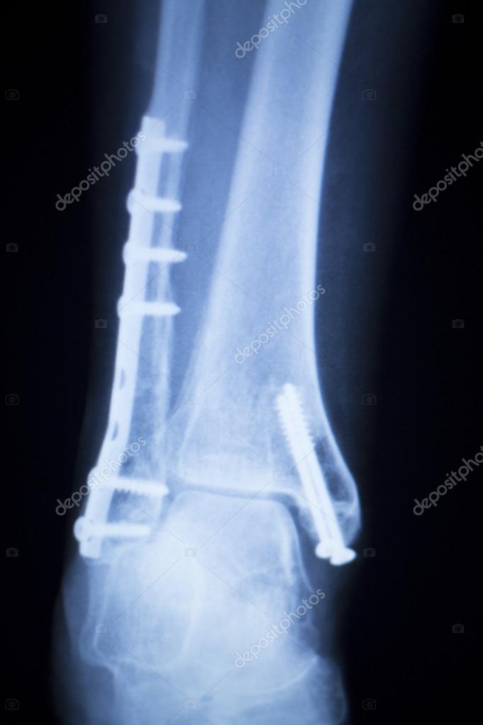 Ankle injury metal implant xray scan — Stock Photo © edwardolive 105396008