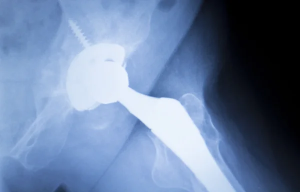 Hip replacement metal implant xray scan