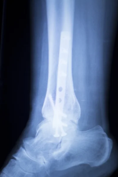 Ankle injury metal implant xray scan — Stock Photo, Image