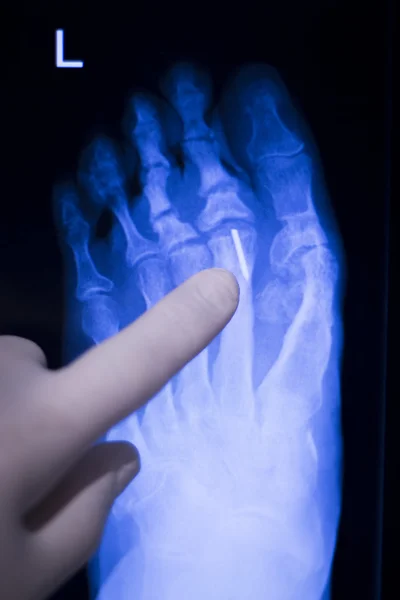 Foot toes metal implant xray scan — Stock Photo, Image