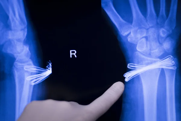 腕关节损伤金属植入物的 x 射线扫描 — 图库照片