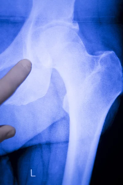 Exploración de rayos X de la articulación de cadera — Foto de Stock