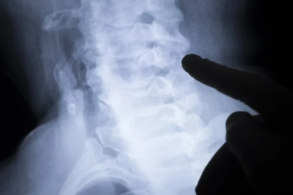 Сканування рентгенівських знімків шиї хребта — стокове фото