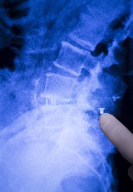 Omurga geri metal implant xray tarama