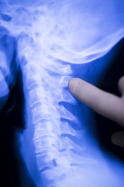 Omurga geri boyun xray tarama