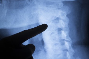 Omurga geri boyun xray tarama