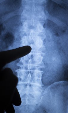 Omurga geri boyun xray tarama