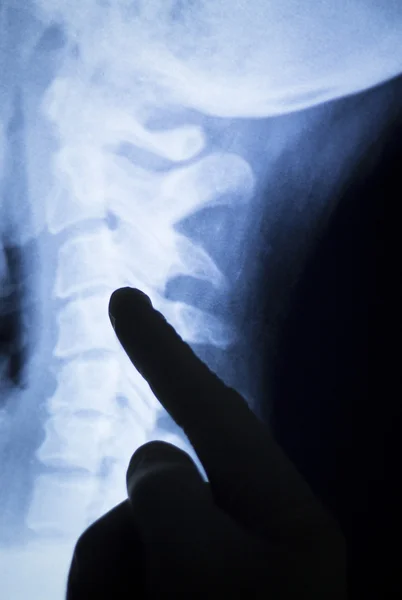 Σπονδυλικής στήλης πίσω λαιμό xray σάρωση — Φωτογραφία Αρχείου
