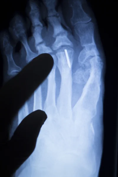 脚的脚趾金属植入物的 x 射线扫描 — 图库照片