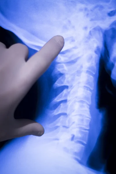 Escáner de radiografía de columna posterior del cuello — Foto de Stock