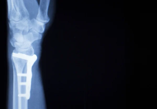 Pulso lesão metal implante varredura de raios X — Fotografia de Stock