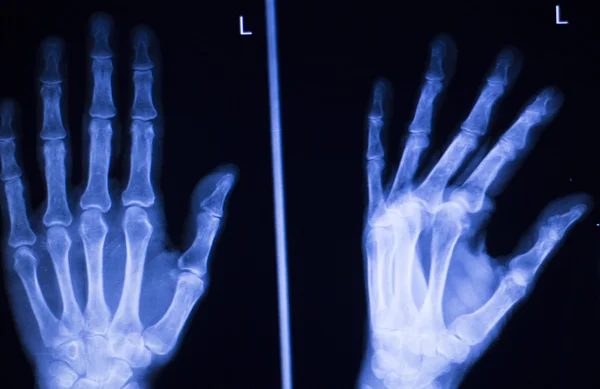 手和手指损伤 x 射线扫描 — 图库照片