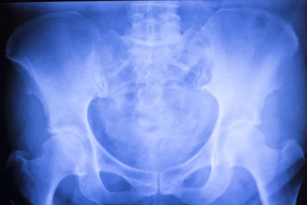 Exploración por rayos X de implante quirúrgico de articulación de cadera — Foto de Stock
