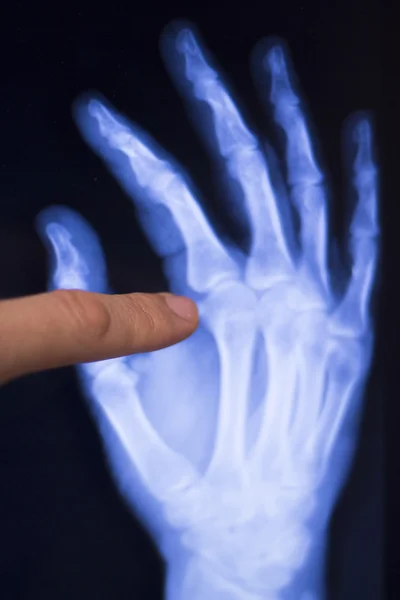 手和手指损伤 x 射线扫描 — 图库照片