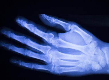 El ve parmak yaralanma xray tarama