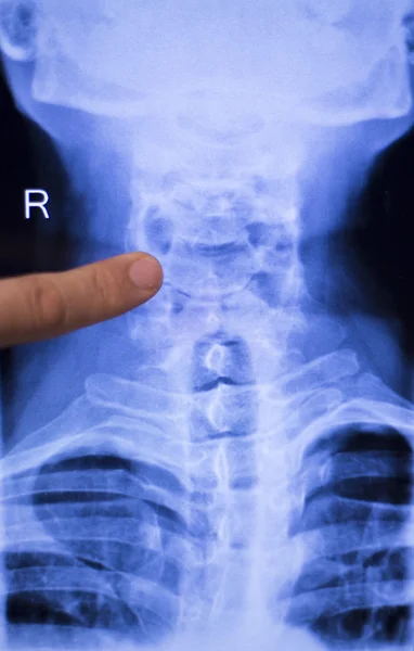 Spine back neck xray scan — Stock Photo, Image