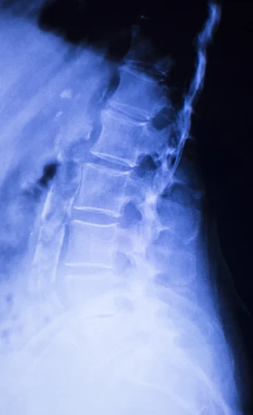 Spine back neck xray scan — Stock Photo, Image