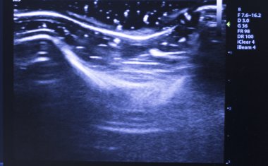 Ultrasound ecograph EPI ecography clipart