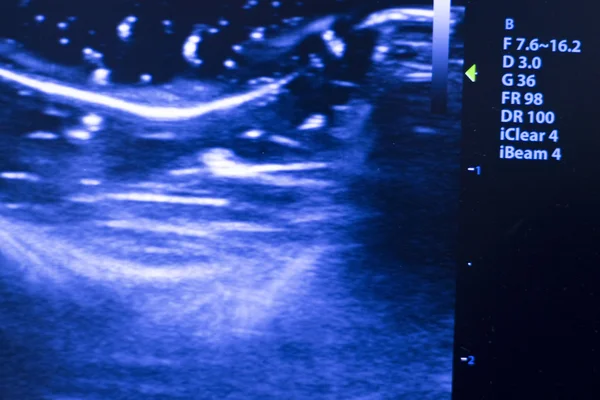 USG ecograph Epi echografii — Zdjęcie stockowe