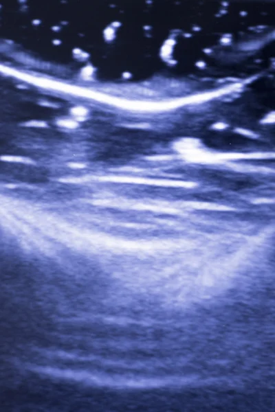 Ultrasound ecograph EPI ecography — Stock Photo, Image