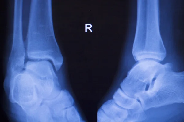 Πόδι τραυματισμού στον αστράγαλο xray σάρωση — Φωτογραφία Αρχείου