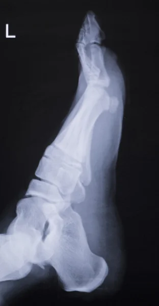 脚踝关节损伤 x 射线扫描 — 图库照片