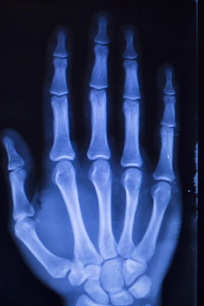 Lesión de mano dedos escaneo de rayos X — Foto de Stock