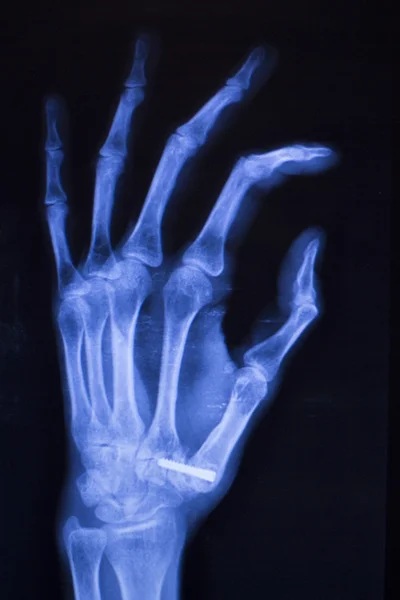 Mão lesão dedos xray varredura — Fotografia de Stock