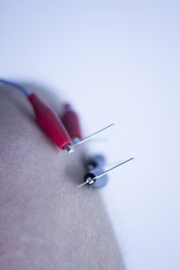 Electroacupunture acupunture iğneler