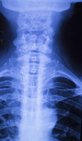 Neck and spine injury xray scan — Stock Photo, Image