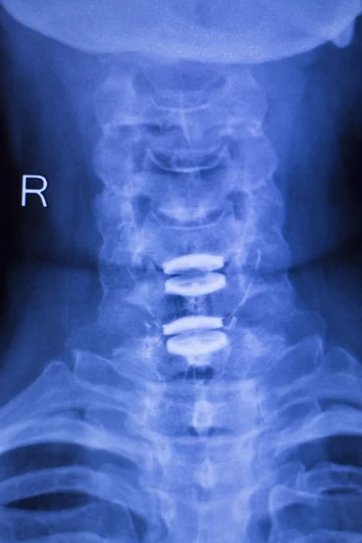 Neck and spine injury xray scan — Stock Photo, Image