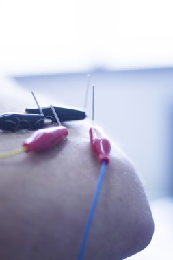 Electroacupunture acupunture iğneler