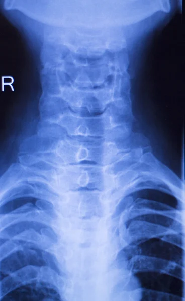 Nyak és a gerinc sérülés xray scan — Stock Fotó